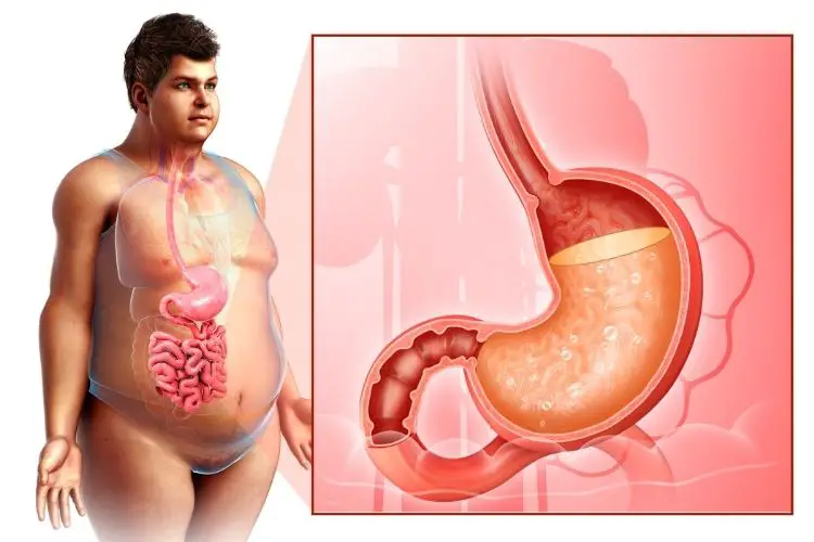 keto and bariatric